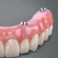 Are All-on-Four Dentures Removable?