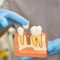 Why Temporary Prosthetics Are an Important Part of the All-on-Four Process