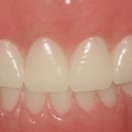 Can Dentures Be Adjusted to Fit Tighter?