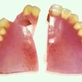 Can Broken Dentures Be Glued Back Together?
