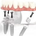 The Advantages of All-On-Four Dental Implants