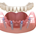 What Are the Risks of All-on-Four Dental Implants?