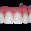 Why More And More People Are Opting For All-on-Four Dentures In Sydney
