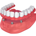 Can All-on-Four Dentures Be Adjusted?