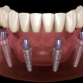 How All-On-Four Dentures With Dental Implants Can Transform Your Smile In London
