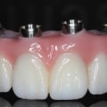 Do I Need to See a Dentist Regularly if I Have All on Four Dentures?