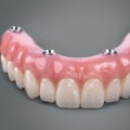 How Long Does All-on-4 Denture Last?