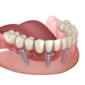 Can I Speak Normally with All-On-Four Dentures?