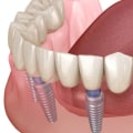 Will All-on-Four Dentures Feel Natural in Place?