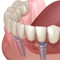 Recovering from All-on-Four Dental Implants: How Long Does It Take?