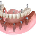 Making The Right Choice: How To Find The Best Dentist For All-On-Four Dentures In Monroe