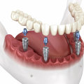 All-on-Four Dentures And Veneers In Round Rock: How They Can Transform Your Smile And Boost Your Confidence