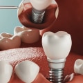Exploring Alternatives to All-on-Four Dental Implants