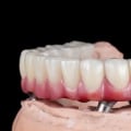 The Hidden Challenges of Adapting to Full-Arch Implant-Supported Dentures