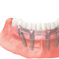 A Perfect Solution For Missing Teeth In Austin, TX: Benefits Of All-On-Four Dentures