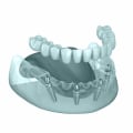 The Role Of Children’s Emergency Dentists In Basel With All-on-four Dentures