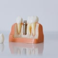 Revolutionizing Tooth Replacement: Mcgregor's All-on-four Dentures And Dental Implants