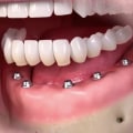 Will My Gums Be Visible When I Wear My All-on-Four Dentures in Place?