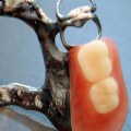 What is the Most Expensive Type of Denture?