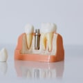 Revolutionize Your Smile: All-on-four Dentures In Helotes, TX - A Comprehensive Guide To Dental Services