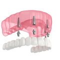 All-On-4 Dental Implants Vs. All-On-4 Dentures: Which Is Right For You In Honolulu