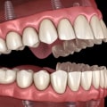 Cleaning and Storing All-on-4 Dental Implants: What You Need to Know