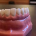 What are All-on-Four Dental Implants?