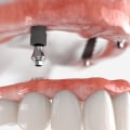 What is the Difference Between Snap-in Dentures and All-on-4 Implants?