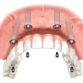 Transforming Smiles In Pflugerville, TX: How Invisalign Works Together With All-On-Four Dentures For Optimal Results