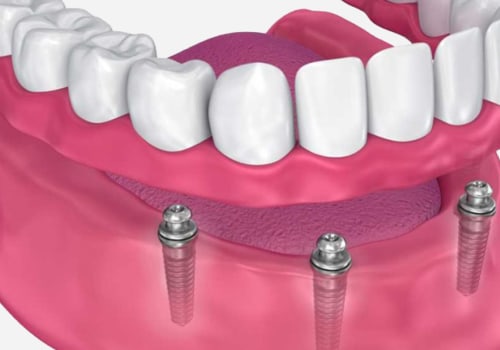 Can I Still Play Sports with My All-on-Four Dentures in Place?