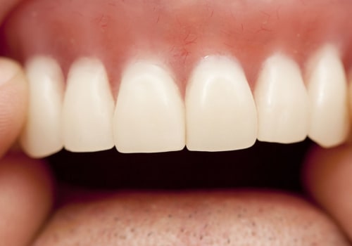 When Should You Replace Your Dentures?