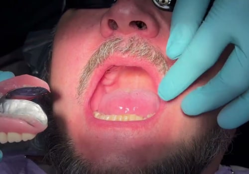 Complete Your Smile Makeover: Combining Invisalign And All-On-Four Dentures In Georgetown, TX