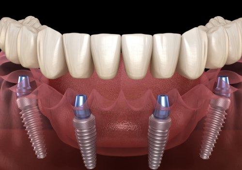 The Complete Guide To All-On-Four Dentures In London: Everything You Should Know