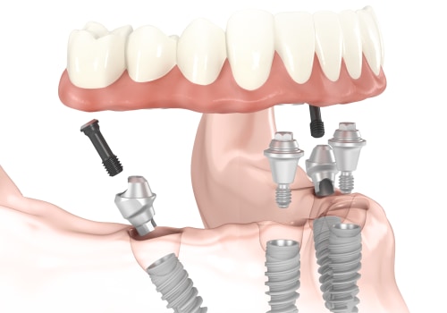 Revolutionize Your Dental Health: Exploring All-on-Four Dentures In Conroe, TX
