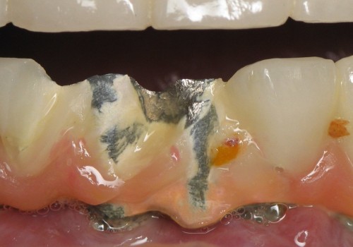Can All-on-Four Dentures Be Repaired If They Break?