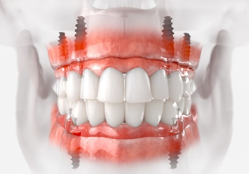Restore Your Confidence With All-on-Four Dentures By Expert Dentists In McGregor, TX