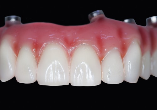 Enhance Your Quality Of Life With All-On-Four Dentures: A Holistic Approach In Sydney Dentistry