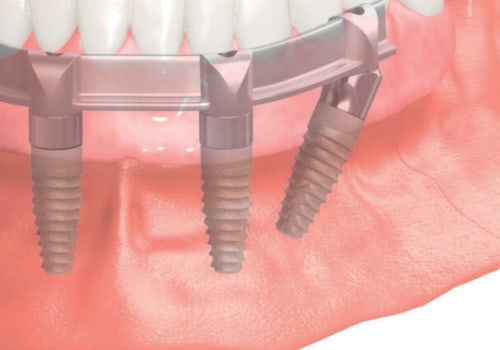 Smile Confidently Again With All-On-Four Dentures In Waco, TX