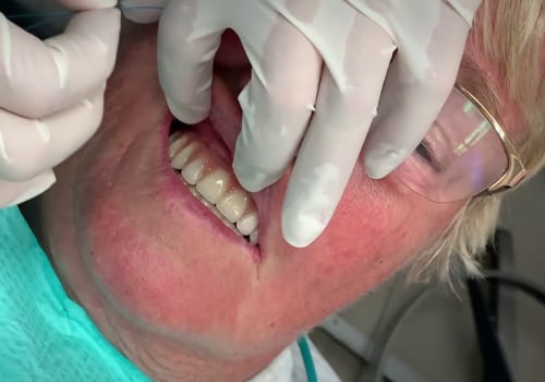Brushing and Flossing with All on Four Dental Implants