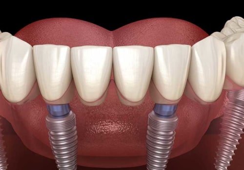 What Type of Anesthesia is Used for All-on-Four Dental Implants?