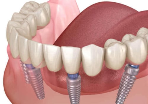 Can All-on-Four Dental Implants Be Whitened?