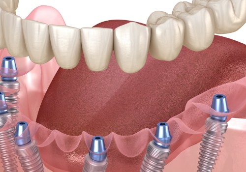 What Type of Denture Makes Patients the Happiest?