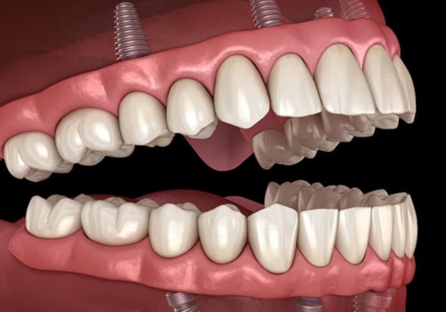 Can I Still Eat Normally with All-on-Four Dentures?