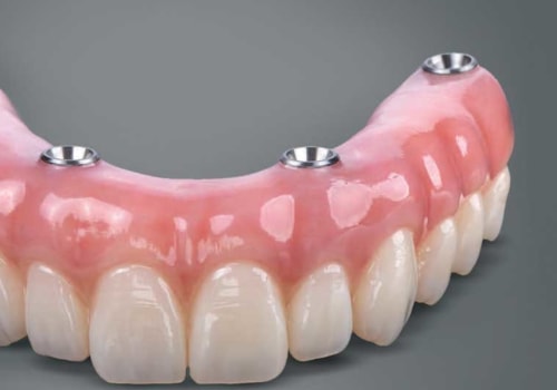 Are All-on-Four Dentures Removable?