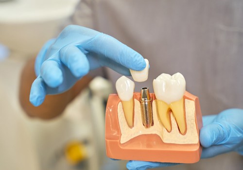 Why Temporary Prosthetics Are an Important Part of the All-on-Four Process