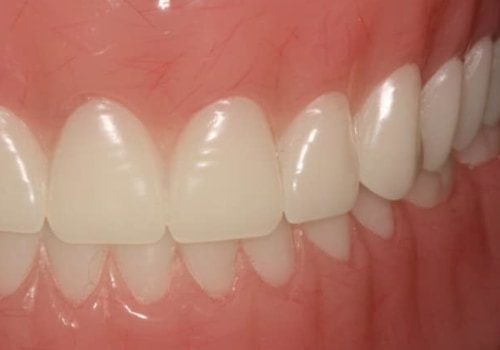 Can Dentures Be Adjusted to Fit Tighter?