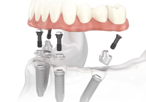 The Advantages of All-On-Four Dental Implants