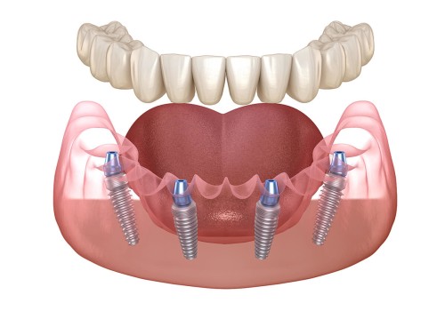 What Are the Risks of All-on-Four Dental Implants?