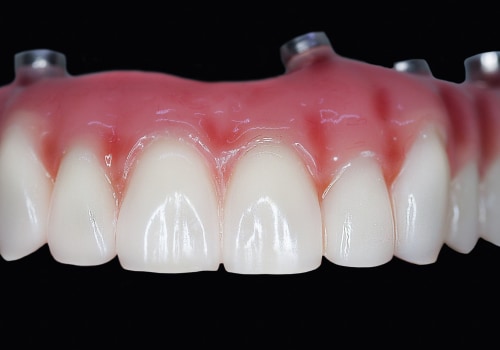 Why More And More People Are Opting For All-on-Four Dentures In Sydney