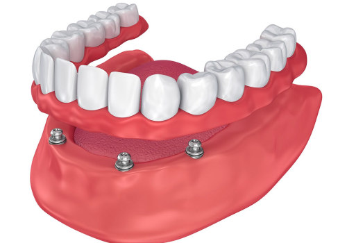 Can All-on-Four Dentures Be Adjusted?